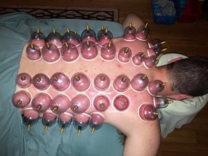 cupping behandeling